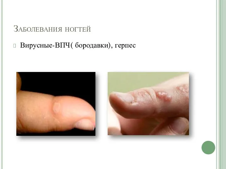Заболевания ногтей Вирусные-ВПЧ( бородавки), герпес