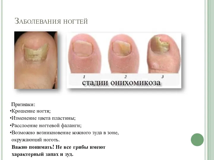 Заболевания ногтей Признаки: Крошение ногтя; Изменение цвета пластины; Расслоение ногтевой фаланги; Возможно возникновение