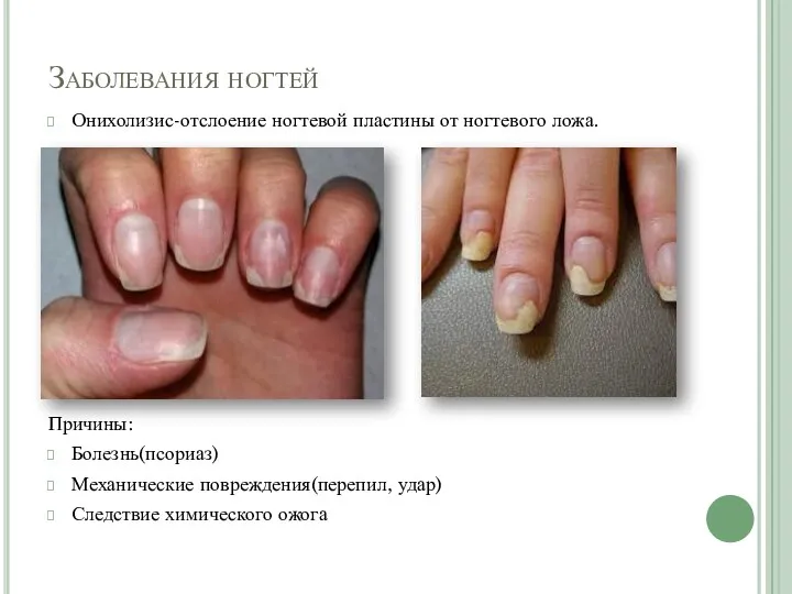 Заболевания ногтей Онихолизис-отслоение ногтевой пластины от ногтевого ложа. Причины: Болезнь(псориаз) Механические повреждения(перепил, удар) Следствие химического ожога