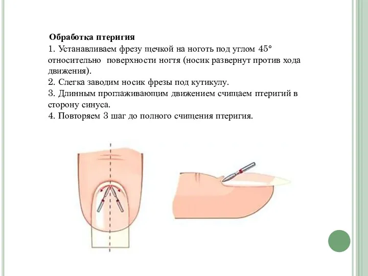 Обработка птеригия 1. Устанавливаем фрезу щечкой на ноготь под углом