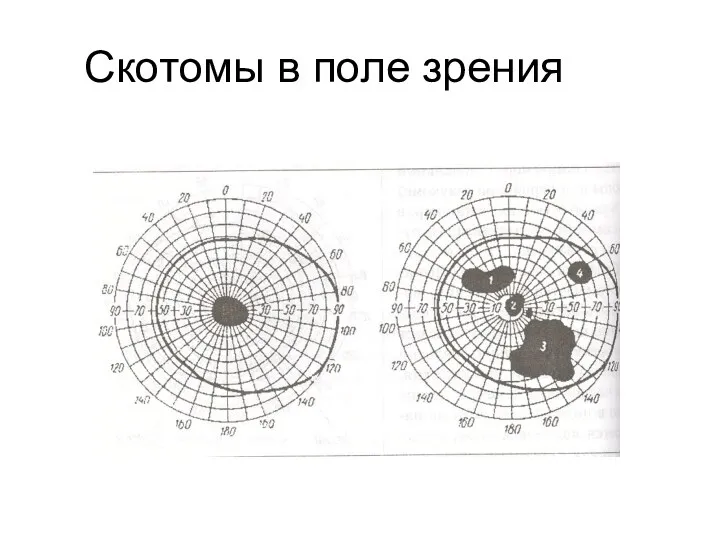 Скотомы в поле зрения