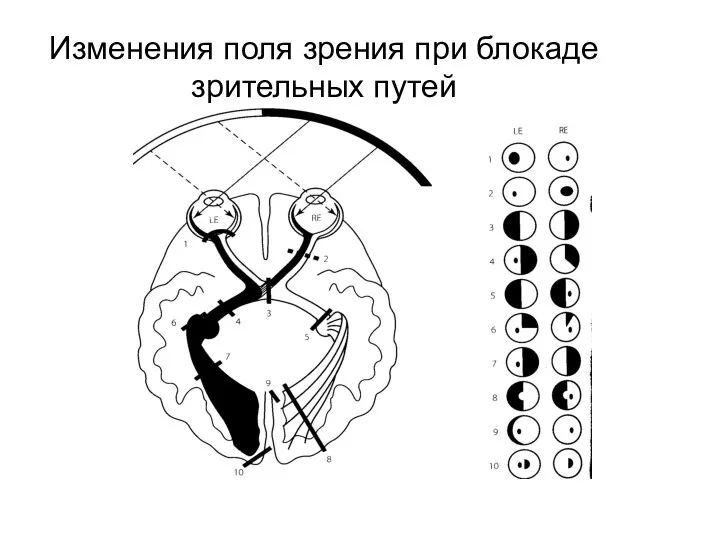 Изменения поля зрения при блокаде зрительных путей