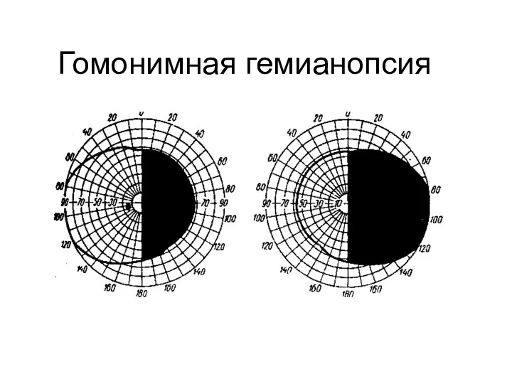 Гомонимная гемианопсия