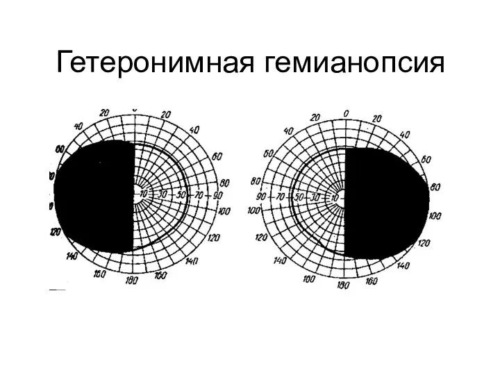 Гетеронимная гемианопсия