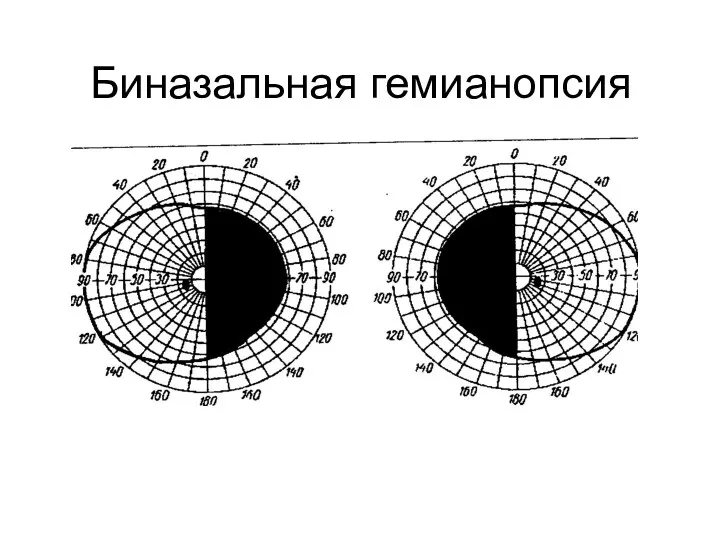 Биназальная гемианопсия