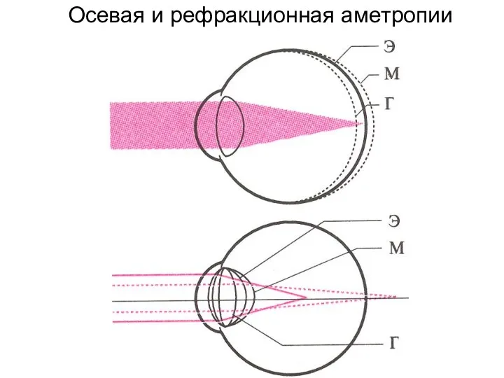 Осевая и рефракционная аметропии