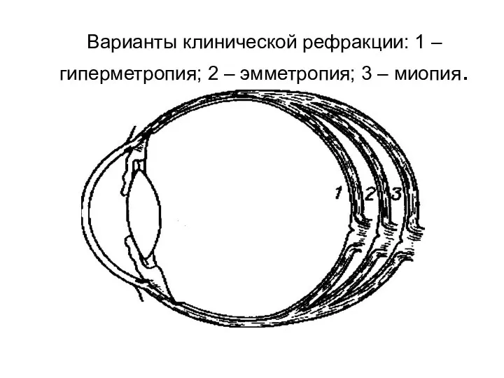 Варианты клинической рефракции: 1 – гиперметропия; 2 – эмметропия; 3 – миопия.