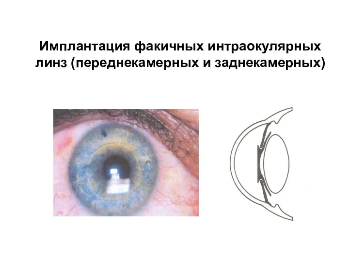 Имплантация факичных интраокулярных линз (переднекамерных и заднекамерных)