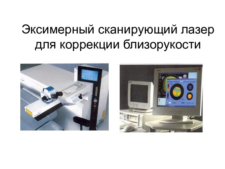 Эксимерный сканирующий лазер для коррекции близорукости