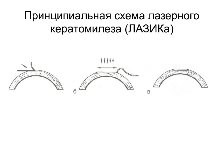 Принципиальная схема лазерного кератомилеза (ЛАЗИКа)