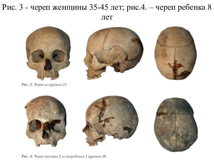 Рис. 3 - череп женщины 35-45 лет; рис.4. – череп ребенка 8 лет