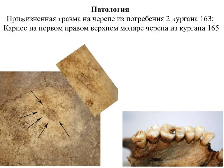 Патология Прижизненная травма на черепе из погребения 2 кургана 163;