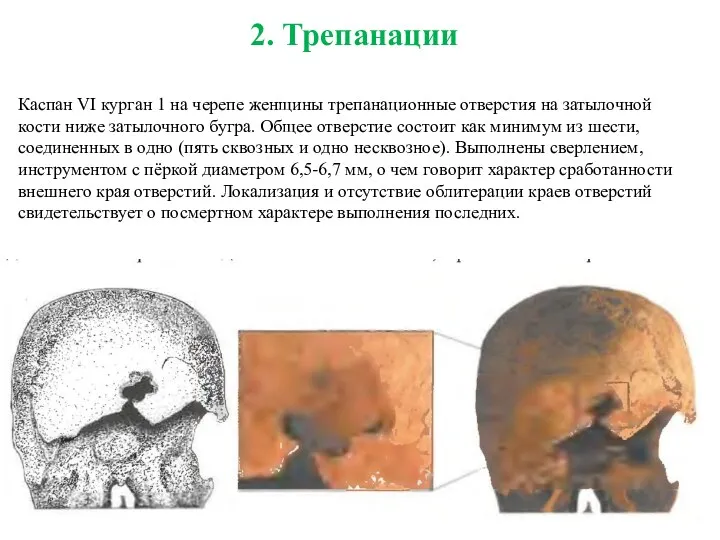 2. Трепанации Каспан VI курган 1 на черепе женщины трепанационные отверстия на затылочной