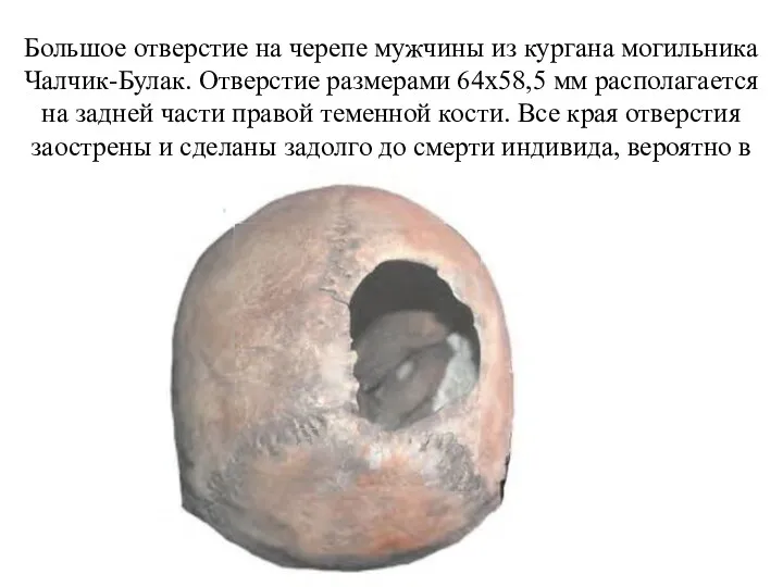 Большое отверстие на черепе мужчины из кургана могильника Чалчик-Булак. Отверстие размерами 64x58,5 мм