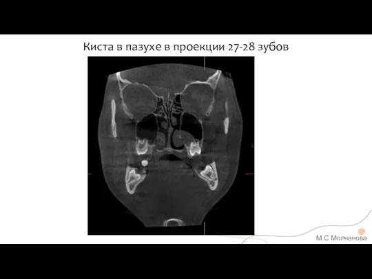 Киста в пазухе в проекции 27-28 зубов