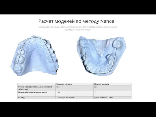 Расчет моделей по методу Nance Определение общей длины зубной дуги и соответствия мезиодистальным размерам коронок зубов