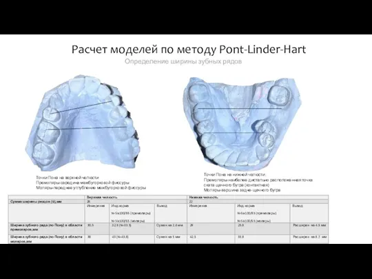 Расчет моделей по методу Pont-Linder-Hart Точки Пона на верхней челюсти: