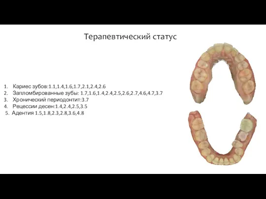 Кариес зубов:1.1,1.4,1.6,1.7,2.1,2.4,2.6 Запломбированные зубы: 1.7,1.6,1.4,2.4,2.5,2.6,2.7,4.6,4.7,3.7 Хронический периодонтит:3.7 Рецессии десен:1.4,2.4,2.5,3.5 5. Адентия 1.5,1.8,2.3,2.8,3.6,4.8 Терапевтический статус