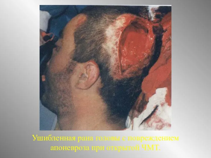 Ушибленная рана головы с повреждением апоневроза при открытой ЧМТ.