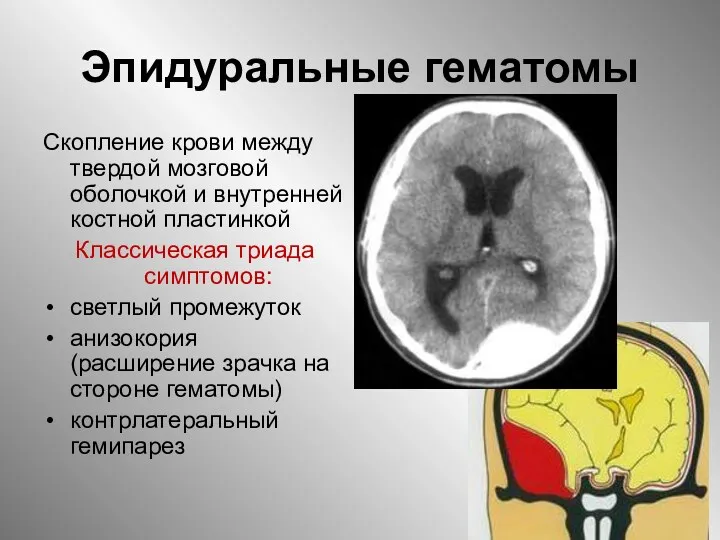 Эпидуральные гематомы Скопление крови между твердой мозговой оболочкой и внутренней