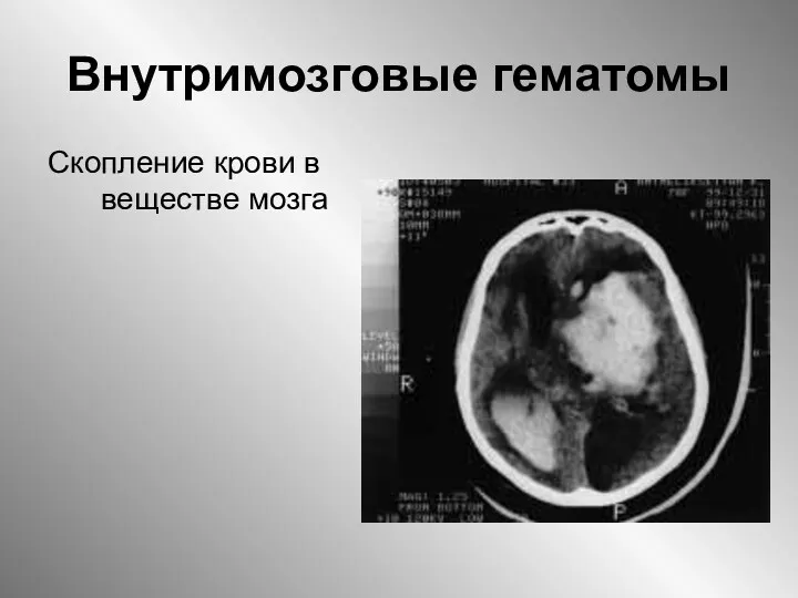 Внутримозговые гематомы Скопление крови в веществе мозга