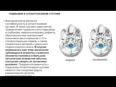 ПОДВЫВИХ В АТЛАНТООСЕВОМ СУСТАВЕ Фактором риска является нестабильность в атлантоосевом