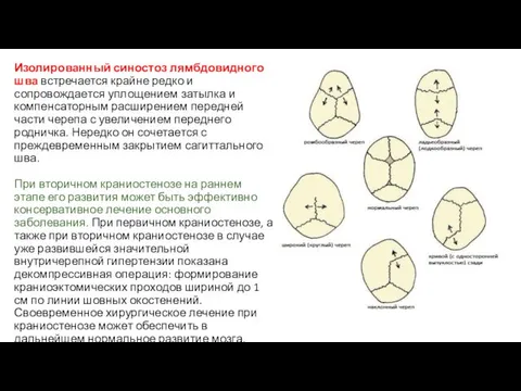 Изолированный синостоз лямбдовидного шва встречается крайне редко и сопровождается уплощением