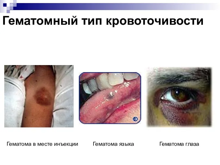 Гематомный тип кровоточивости Гематома в месте инъекции Гематома языка Гематома глаза