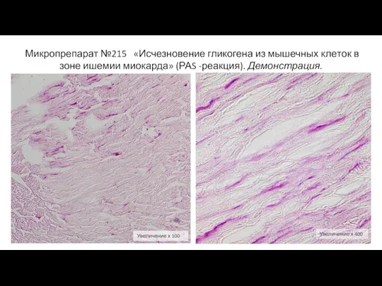 Микропрепарат №215 «Исчезновение гликогена из мышечных кле­ток в зоне ишемии