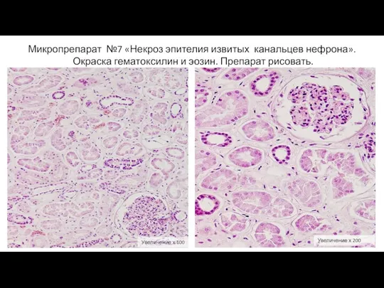 Микропрепарат №7 «Некроз эпителия извитых канальцев нефрона». Окраска гематоксилин и