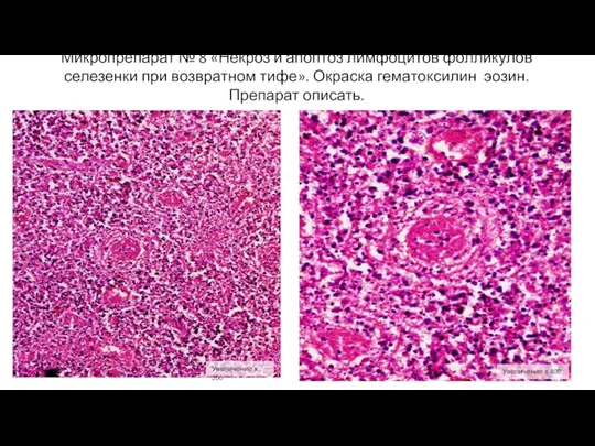 Микропрепарат № 8 «Некроз и апоптоз лимфоцитов фолликулов селезенки при