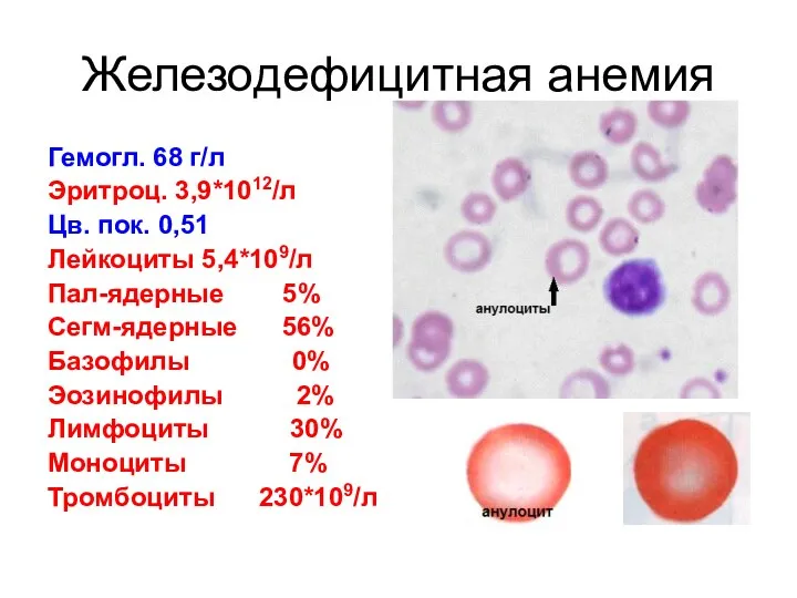 Железодефицитная анемия Гемогл. 68 г/л Эритроц. 3,9*1012/л Цв. пок. 0,51