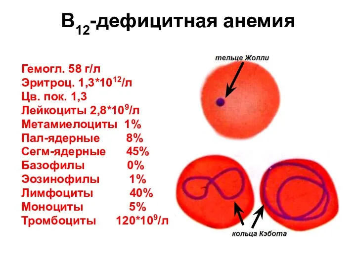 В12-дефицитная анемия Гемогл. 58 г/л Эритроц. 1,3*1012/л Цв. пок. 1,3