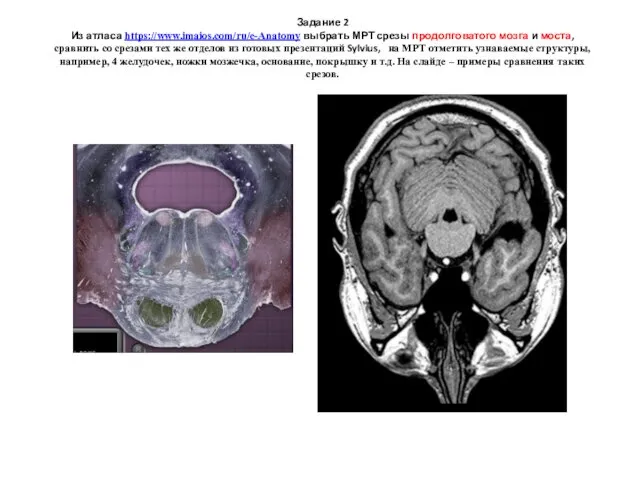 Задание 2 Из атласа https://www.imaios.com/ru/e-Anatomy выбрать МРТ срезы продолговатого мозга