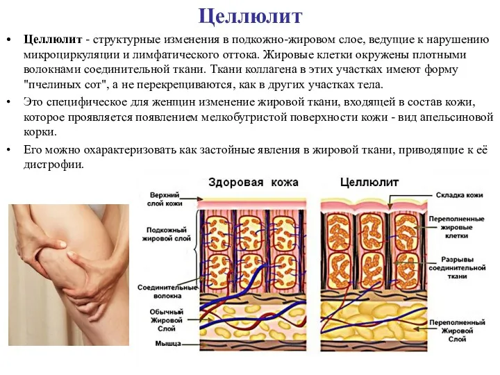 Целлюлит Целлюлит - структурные изменения в подкожно-жировом слое, ведущие к