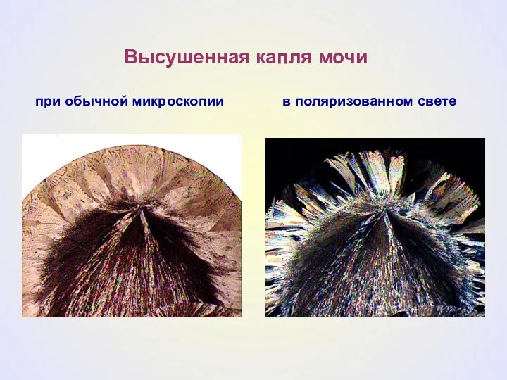 при обычной микроскопии в поляризованном свете Высушенная капля мочи