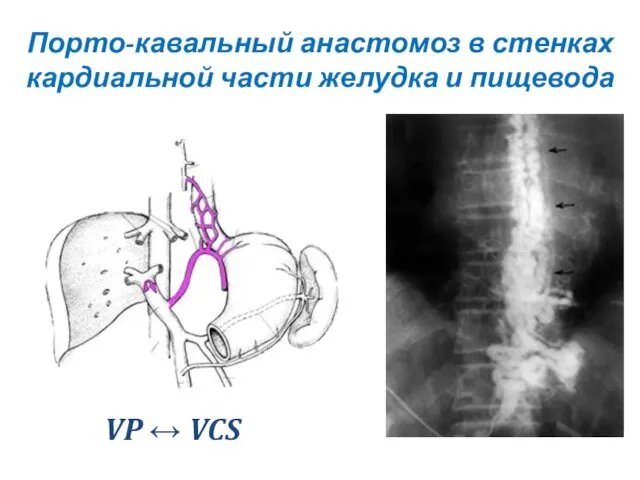 Порто-кавальный анастомоз в стенках кардиальной части желудка и пищевода VP ↔ VCS