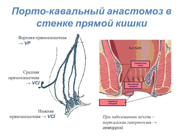 Порто-кавальный анастомоз в стенке прямой кишки Верхняя прямокишечная → VP