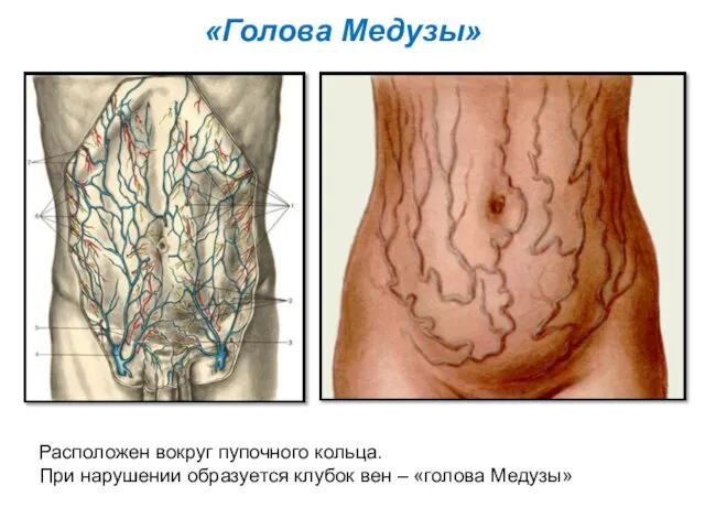 Расположен вокруг пупочного кольца. При нарушении образуется клубок вен – «голова Медузы» «Голова Медузы»