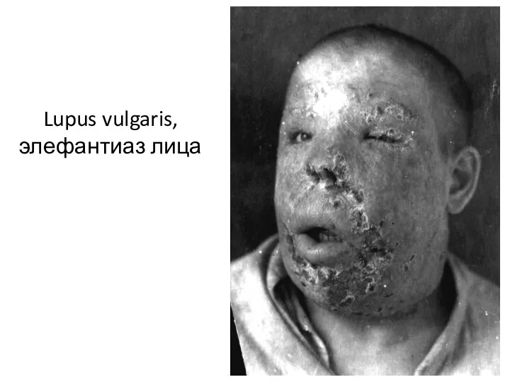 Lupus vulgaris, элефантиаз лица