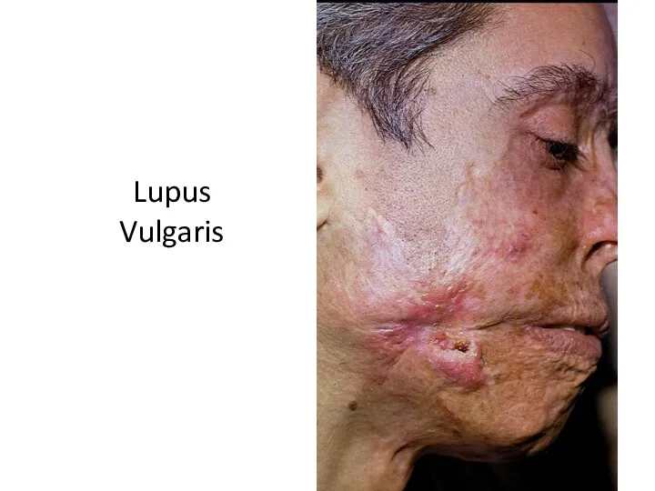 Lupus Vulgaris