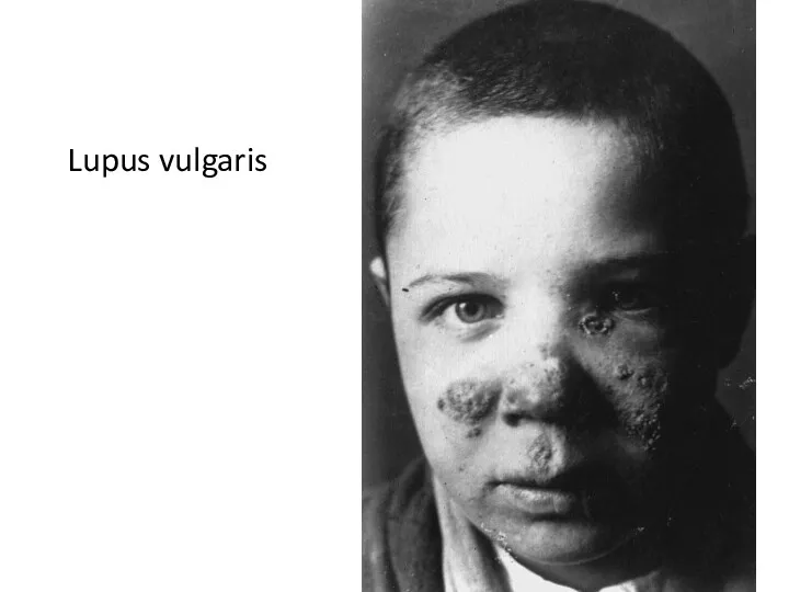 Lupus vulgaris