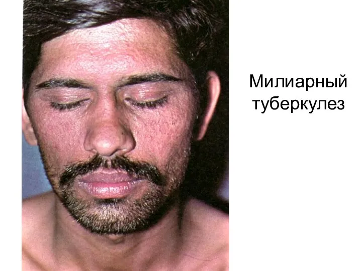 Милиарный туберкулез