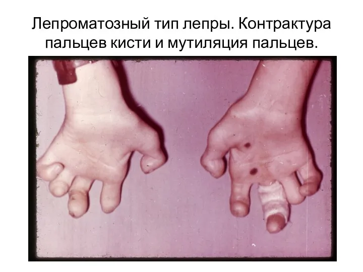 Лепроматозный тип лепры. Контрактура пальцев кисти и мутиляция пальцев.
