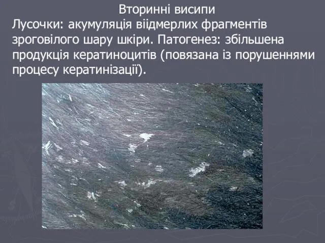 Вторинні висипи Лусочки: акумуляція віідмерлих фрагментів зроговілого шару шкіри. Патогенез: