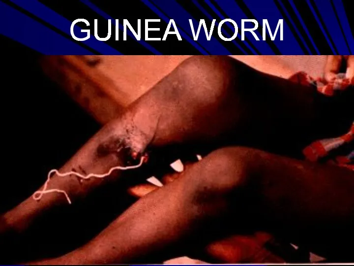 GUINEA WORM