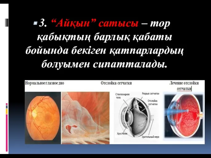 3. “Айқын” сатысы – тор қабықтың барлық қабаты бойында бекіген қатпарлардың болуымен сипатталады.