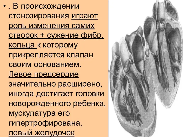 . В происхождении стенозирования играют роль изменения самих створок +