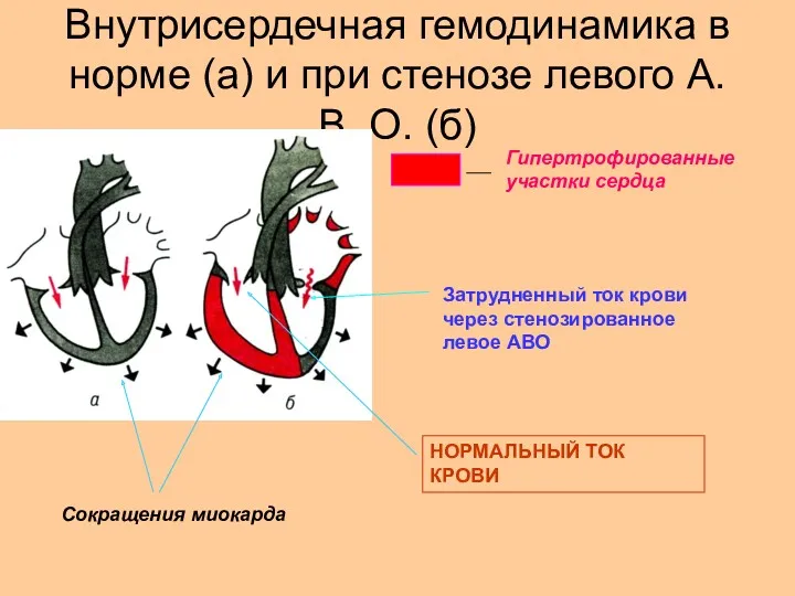 Внутрисердечная гемодинамика в норме (а) и при стенозе левого А.