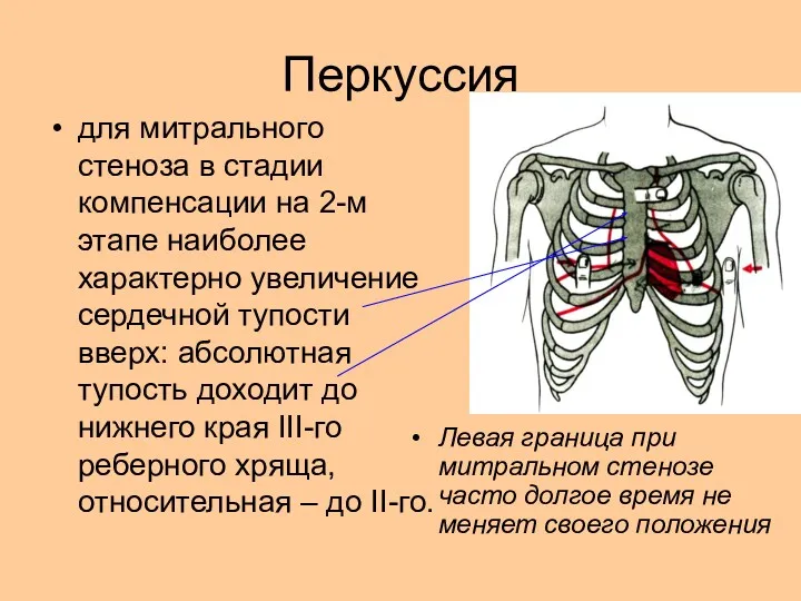 Перкуссия для митрального стеноза в стадии компенсации на 2-м этапе